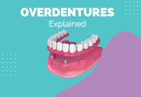 illustration of overdentures showing implant-supported lower denture Title: Visual Guide to How Overdentures Work