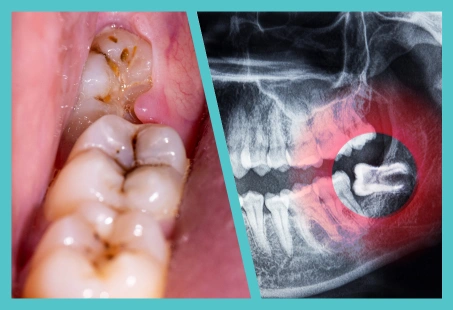 close-up of decayed molars next to an x-ray showing an impacted wisdom tooth highlighted in red. Title: impacted wisdom tooth and tooth decay comparison