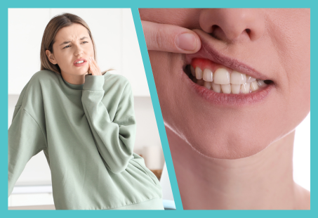 Close-up of a person lifting their upper lip to show red, swollen gums, a common sign of puberty gingivitis.